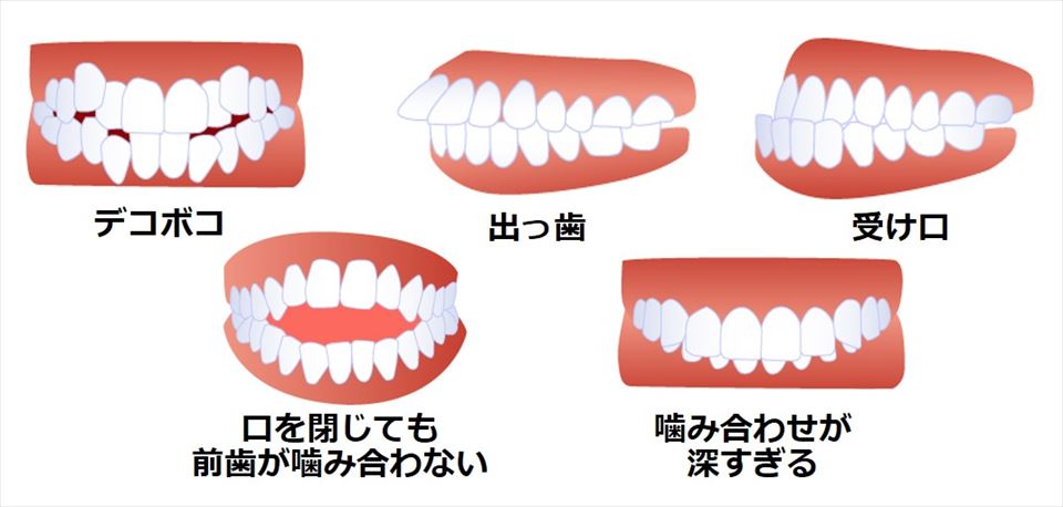 5種類の不正な歯並び
