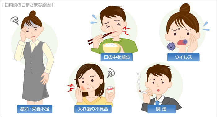 口内炎の様々な原因