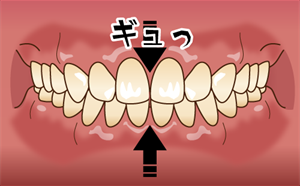 クレンチング（食いしばり）