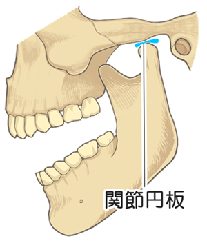 顎の関節が痛み口が開かなくなる