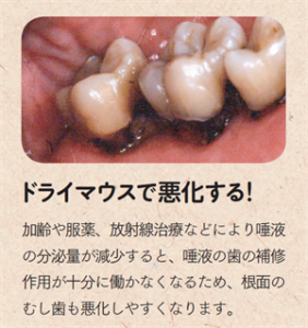 ドライマウスが引き起こす特徴的なむし歯