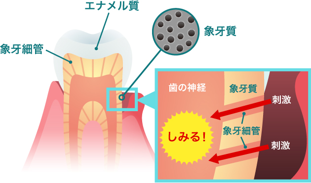知覚過敏症のメカニズム