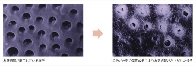 象牙細管の封鎖