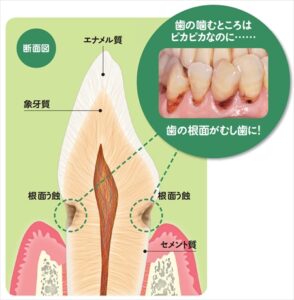 歯ぐき下がりでむし歯になりやすい根部が露出する