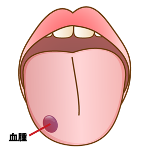 舌や口腔内のトラブル