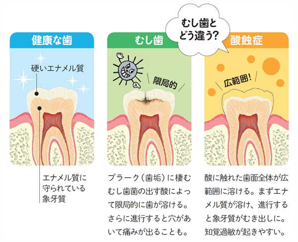 酸蝕症とむし歯との違いは？