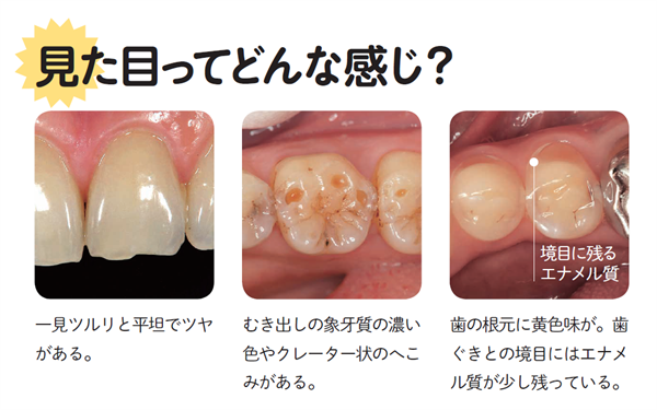 酸蝕症の症状や特徴は？