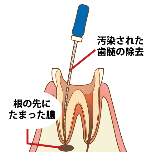 根管治療②