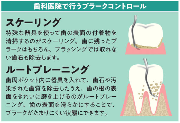 スケーリング、ルートプレーニング