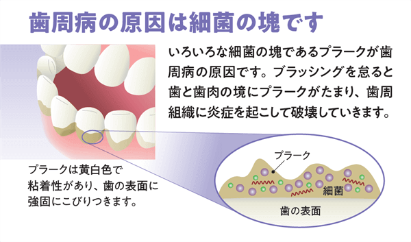 歯周病の主たる原因は細菌の塊です