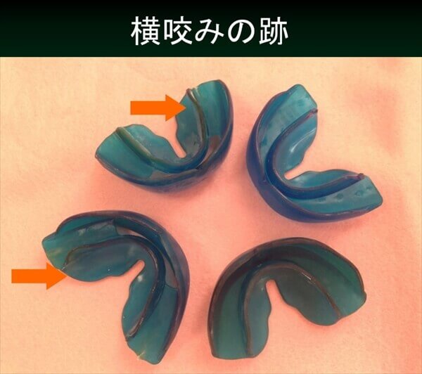 プレオルソは横噛みに弱いのが欠点