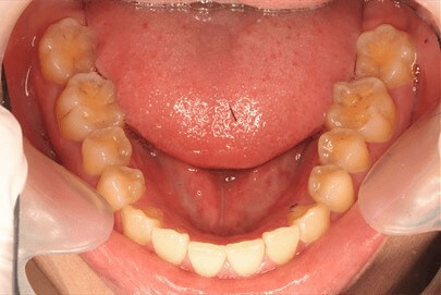 ほぼ正常な歯列