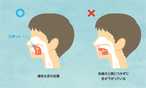 鼻呼吸にしないと歯並びは改善しにくい