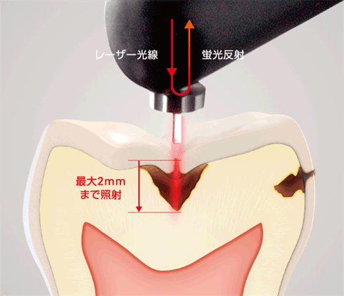 レーザー光を用いた