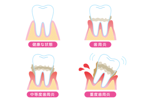 歯周病の進行度合い