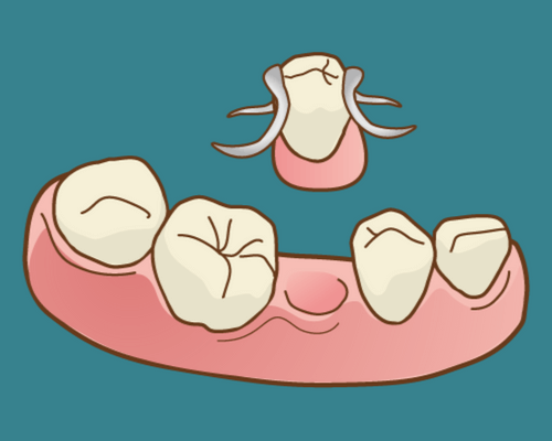 3種の欠損部の治療法（入れ歯）