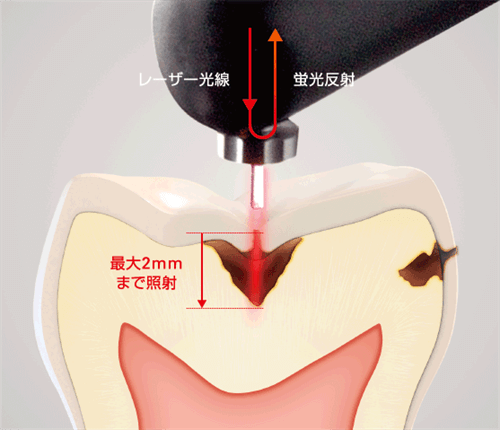 むし歯の深さを数値化するダイアグノデントペンの仕組み