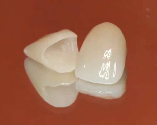 セラミック治療(前歯)