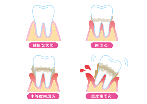 顎 の 骨 が 溶ける 病気