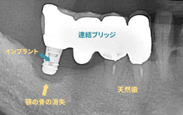 インプラントと天然歯の連結は･･･？