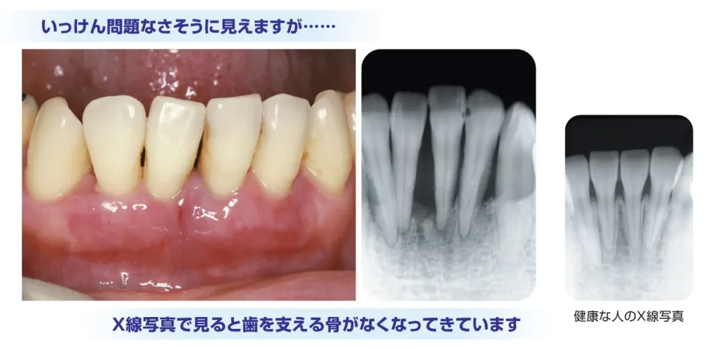 歯周病はアゴの骨が溶ける病気
