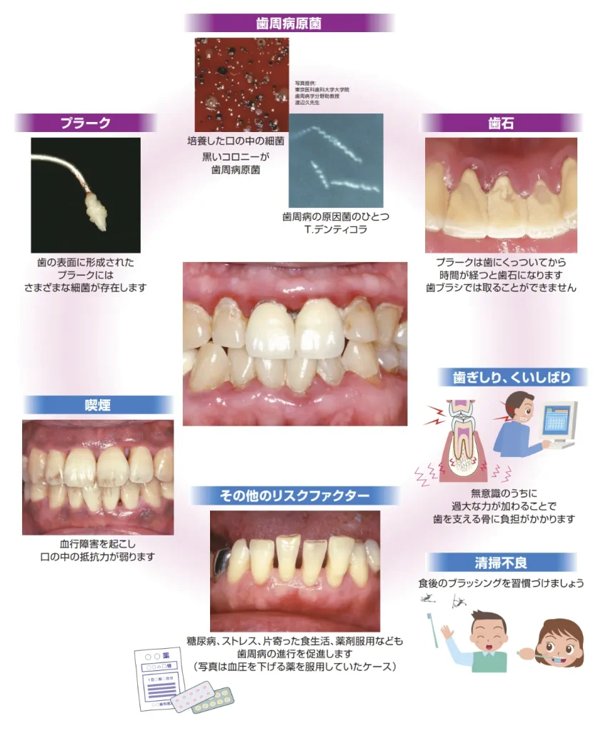 歯周病の大敵、汚れ・喫煙・負担過多