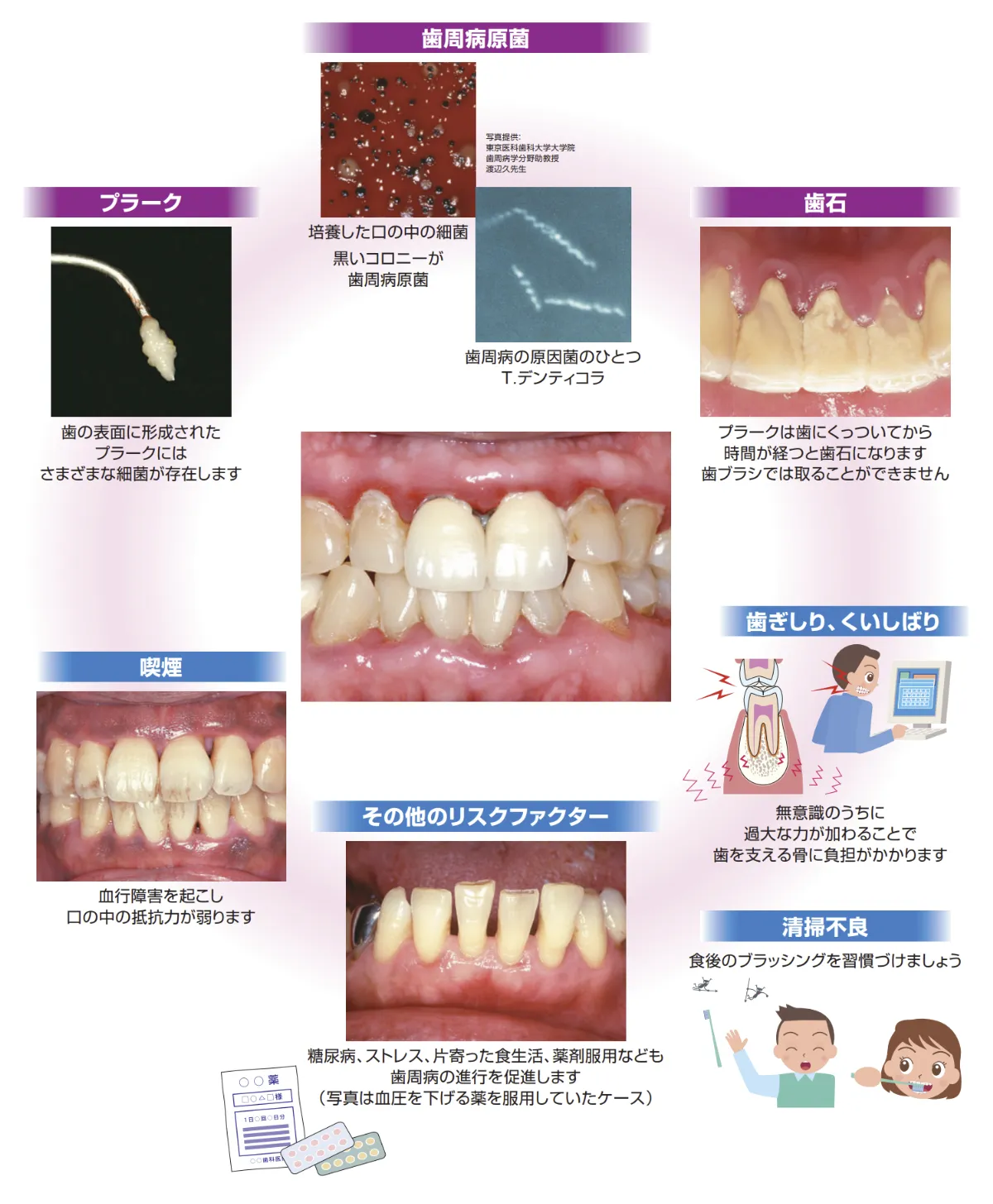 歯周病の大敵、汚れ・喫煙・負担過多