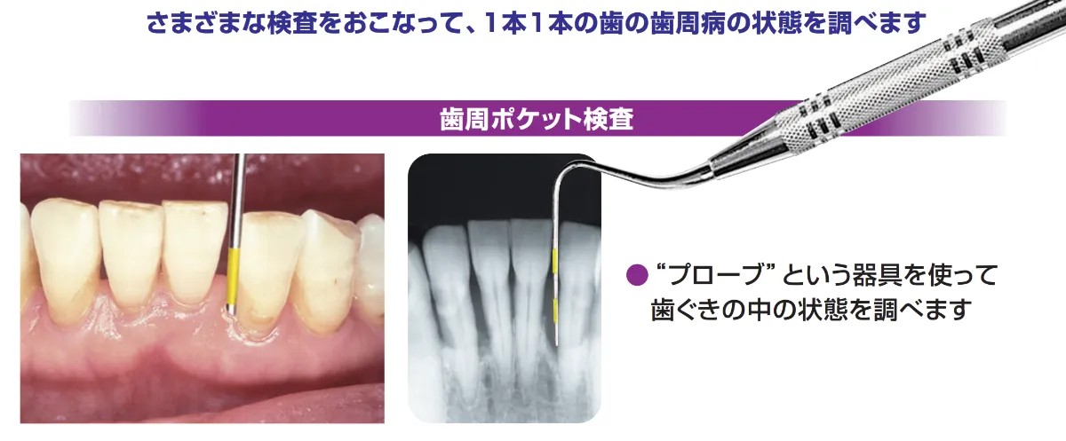 歯周ポケット検査
