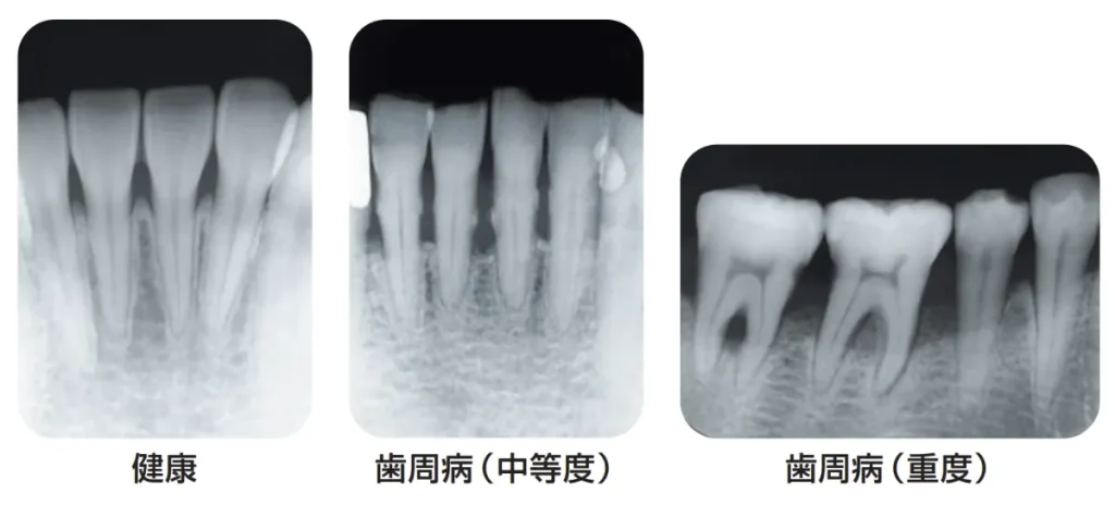 骨の消失のレントゲン画像