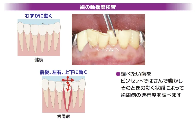 歯の動揺度検査