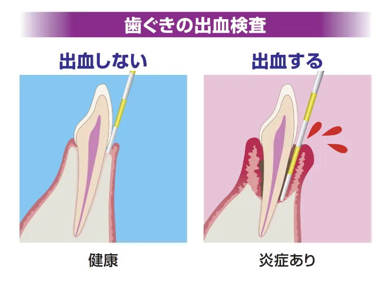 歯ぐきの出血検査