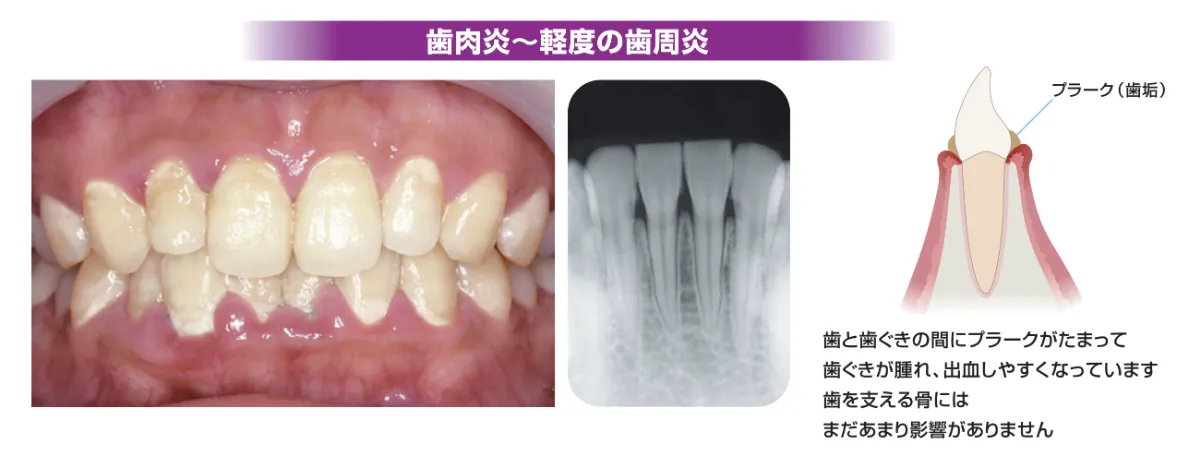 歯肉炎ー軽度の歯周炎