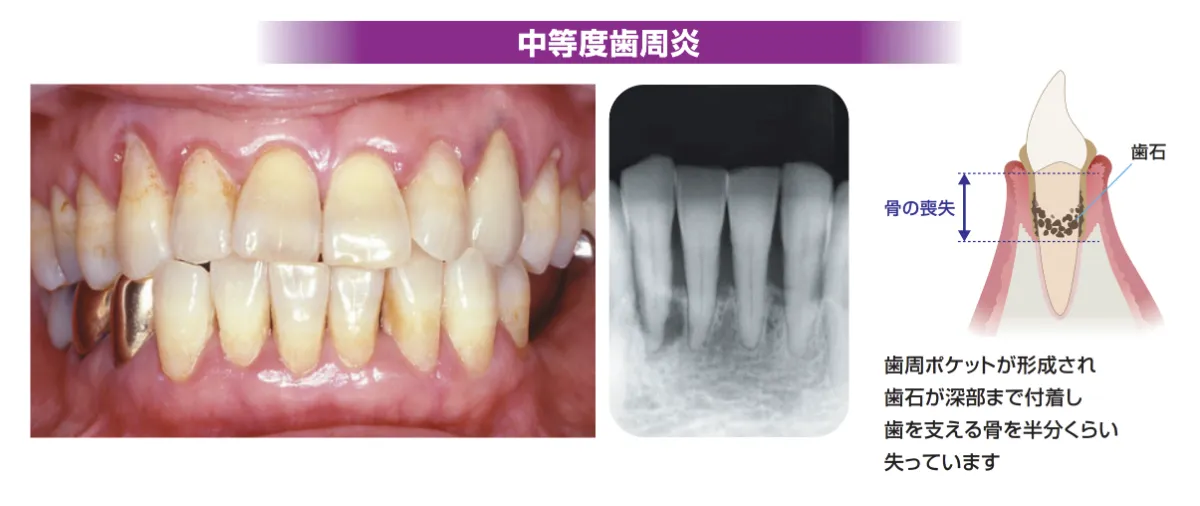 中等度歯周炎