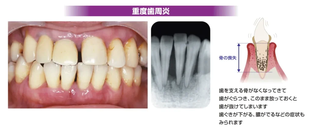 重度歯周炎