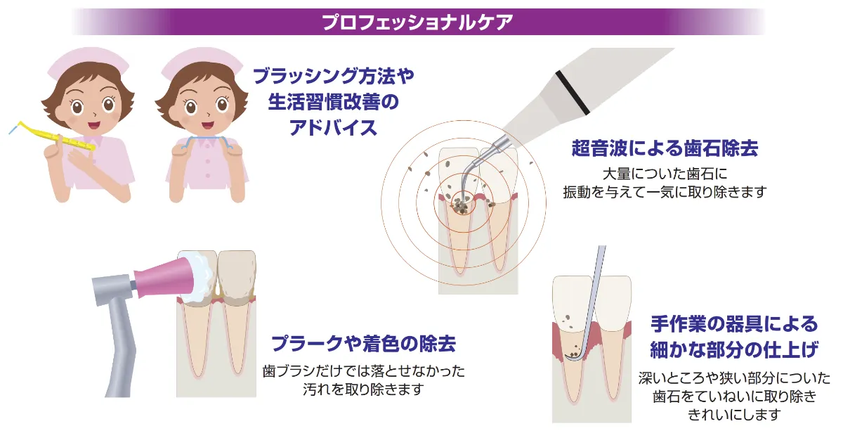 歯周病対策のプロフェッショナルケア