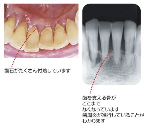 歯槽骨の吸収度合い