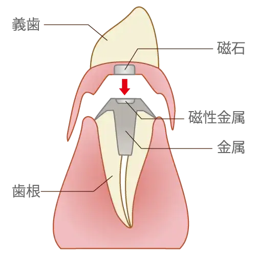 磁性アタッチメントの断面図