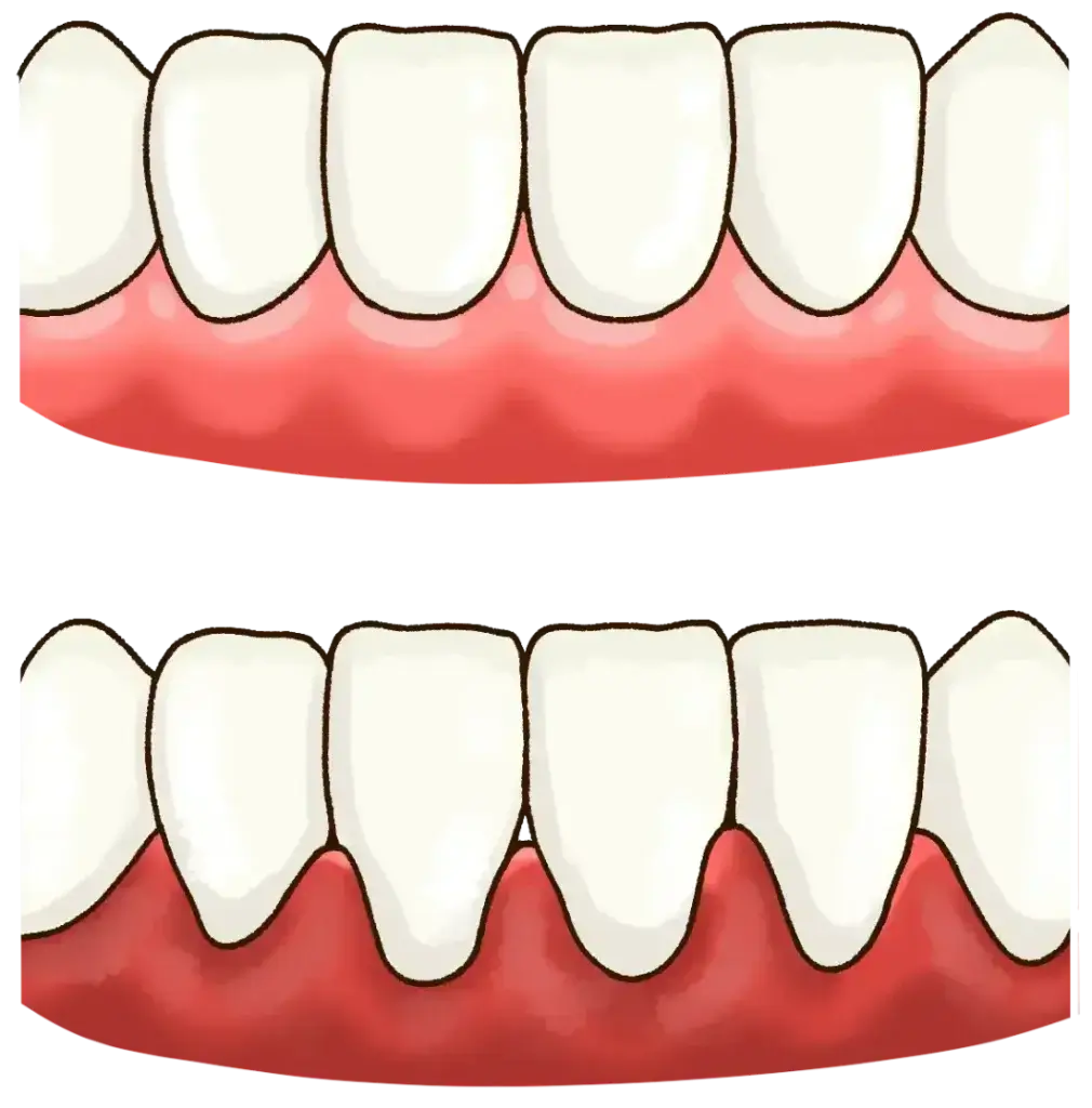 喫煙による歯周病で炎症を起こした歯ぐきのイラスト