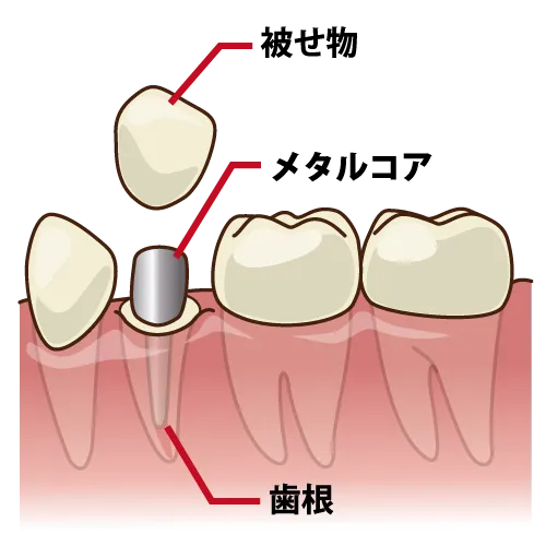 金属アレルギー情報⑤