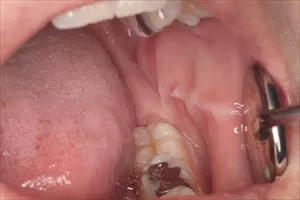 歯列接触癖TCHの症状1