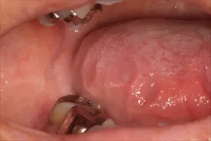 歯列接触癖TCHの症状2