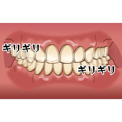顎関節症に繋がる歯ぎしり