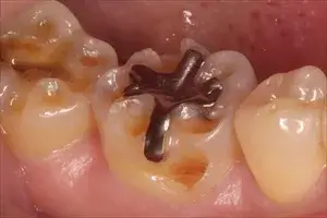 酸蝕症②