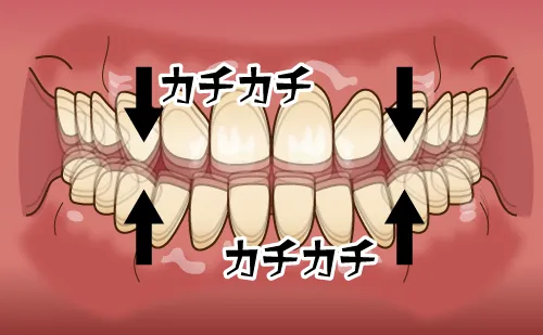 歯ぎしり②