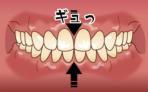 歯ぎしり③