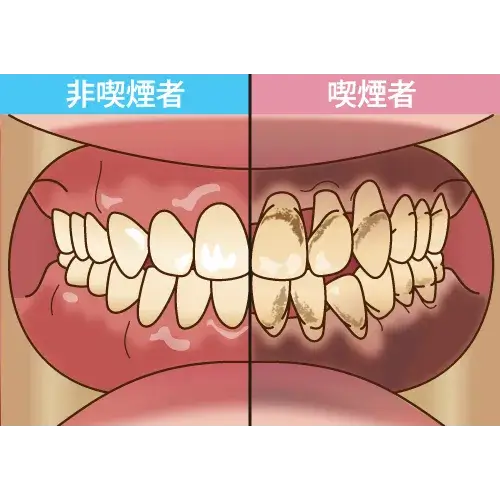 タバコと歯周病-25