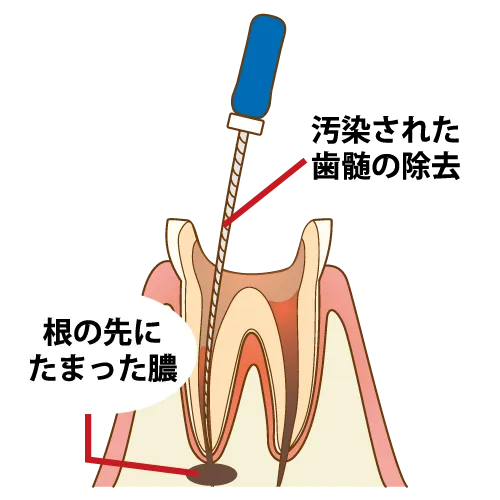 根管治療③