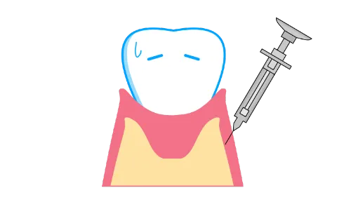 歯科用の麻酔のイメージイラスト