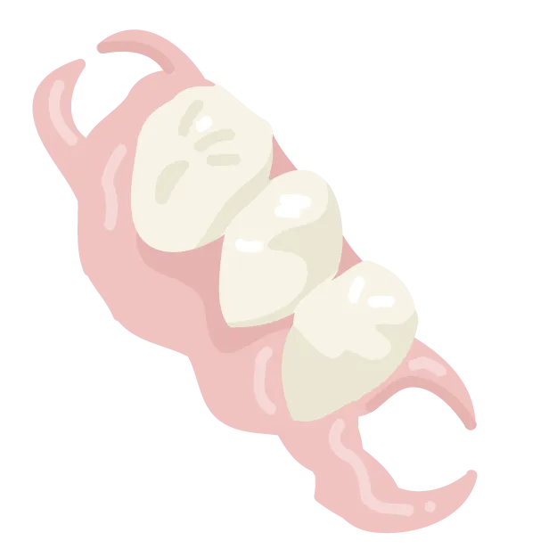ノンクラスプデンチャー②