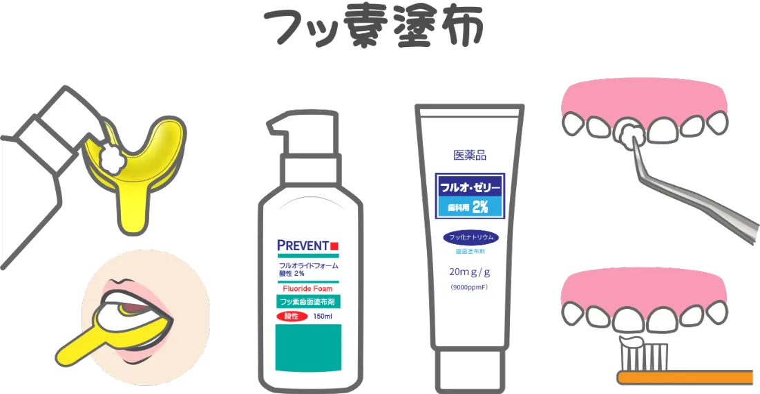 フッ素塗布のイメージイラスト